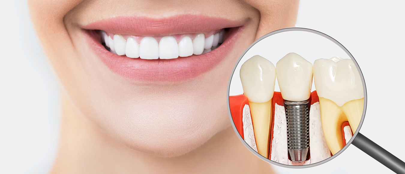 Dental Implants